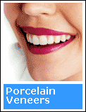 Porcelain Veneers