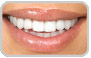 tooth whitening step