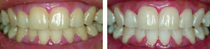 tooth whitening case