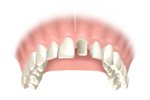 Dental Crown