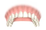 Porcelain Veneers